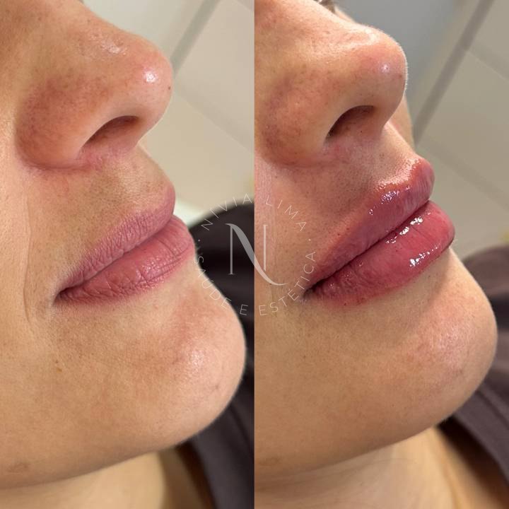 Preenchimento labial: antes à esquerda e depois à direita
