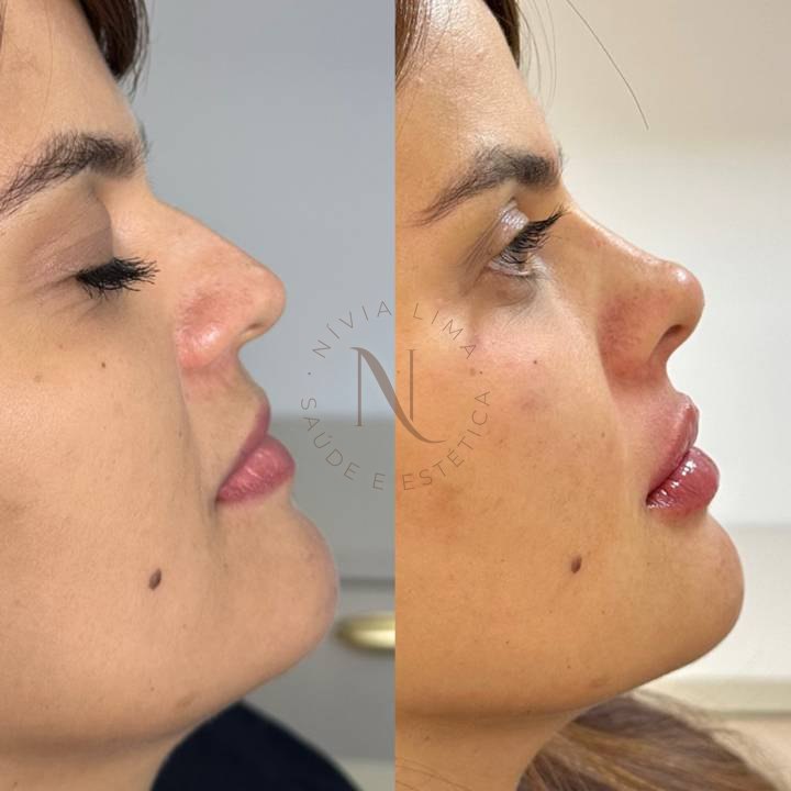 Preenchimento labial e rinomodelação: antes à esquerda e depois à direita