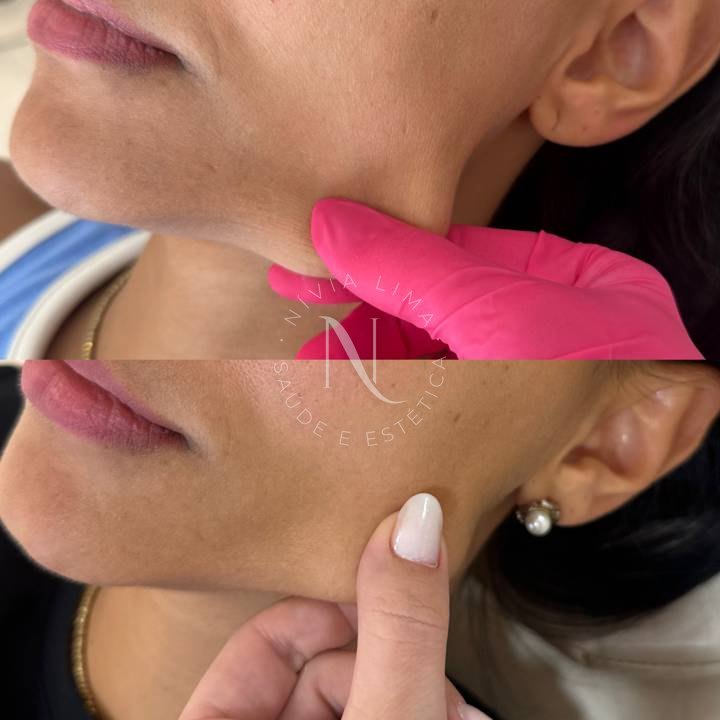 Bioestimulador: antes em cima e depois embaixo
